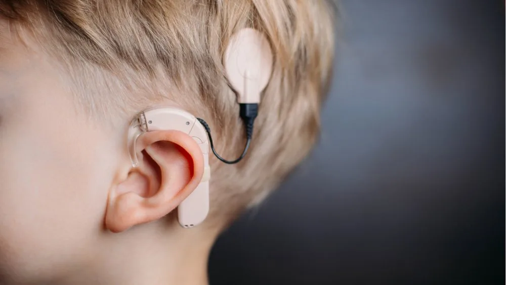 Cochlear Implant
